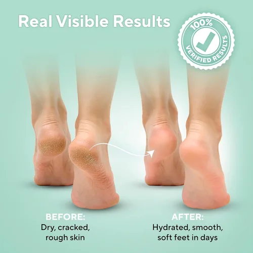 Vista 3 de Lavinso Crema de urea 40% y spray para el cuidado de los pies de atleta, crema hidratante para talones y callos agrietados secos más desodorante