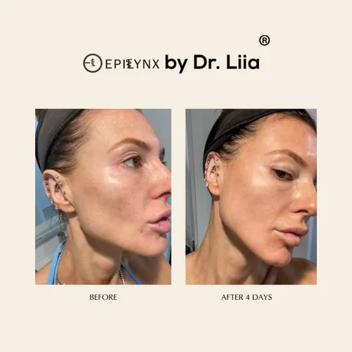 Vista 5 de Suero facial para piel propensa al acné - Hidratante para pieles grasas - Sin gluten y vegano para pieles sensibles con cicatrices de acné EpiLynx