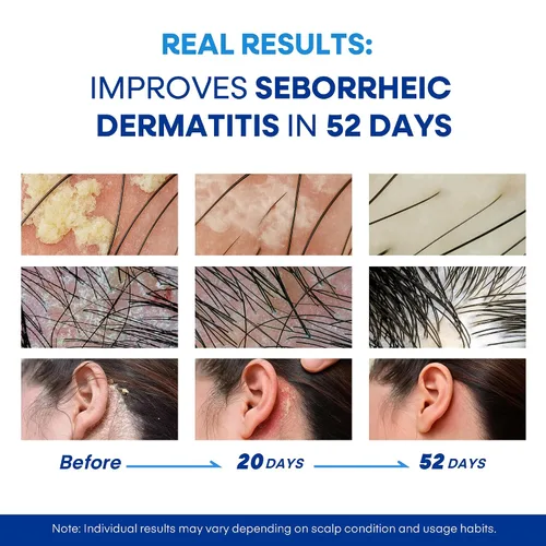 Vista 3 de Champú medicado para la dermatitis seborreica del cuero cabelludo y la psoriasis: Fórmula a base de plantas alivia la picazón, reduce las escamas
