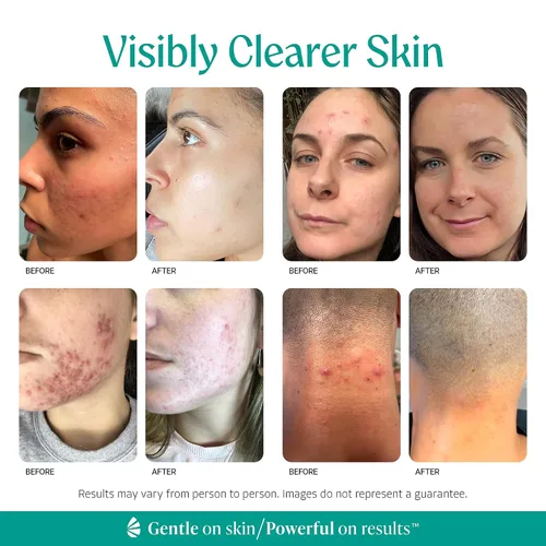 Vista 3 de Suero limpiador facial y corporal con ácido mandélico almendra, nivel 1 para acné, foliculitis, piel envejecida, pelos encarnados, manchas oscuras