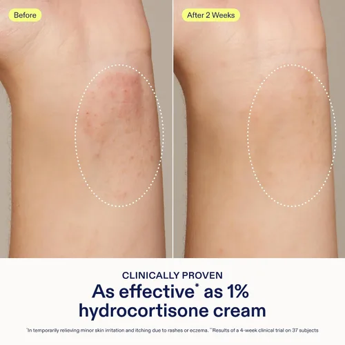 Vista 3 de Skinfix Bálsamo para aliviar la dermatitis con 5% de avena coloidal y vitamina E - 1.7 onzas líquidas - Probado eficaz como hidrocortisona al 1%