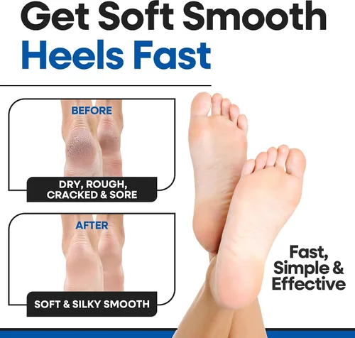 Vista 9 de Calcetines hidratantes para hombres y mujeres Tratamiento de talón agrietado con aloe vera Removedor de callos de talón hidratante Calcetines
