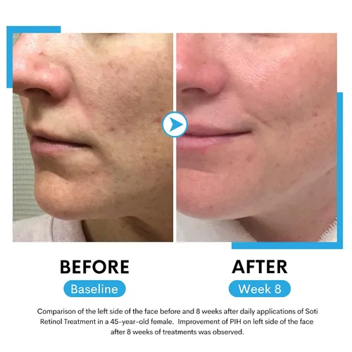 Vista 6 de Suero facial de retinol, reduce arrugas, manchas de edad, marcas postacné. Estimula el colágeno, piel firme, antienvejecimiento con ácido