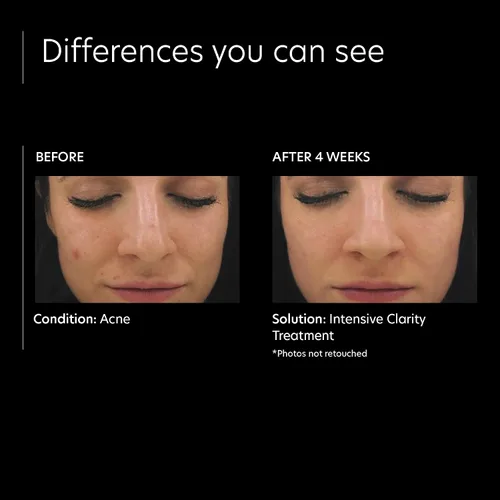 Vista 4 de PCA SKIN Tratamiento de claridad intensiva: 0.5% de retinol de vitamina A pura y suero facial de ácido salicílico al 2% para piel propensa al acné