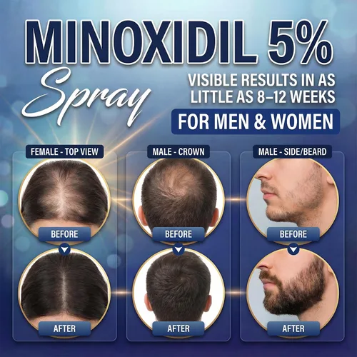 Vista 2 de Minoxidil 5% para hombres (4.1 fl oz), spray avanzado de minoxidil con provitamina B5 y extracto de semilla de ricino, suero de extracto
