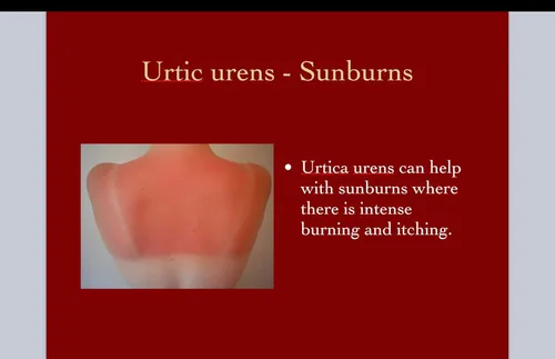 Vista 6 de Urtica Urens Crema 1 Pack