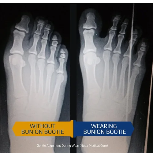 Vista 4 de Corrector de juanetes para mujer, enderezador de dedo gordo y férula - Alivio del dolor Hallux Valgus - Soporte ultrafino para juanetes para atletas