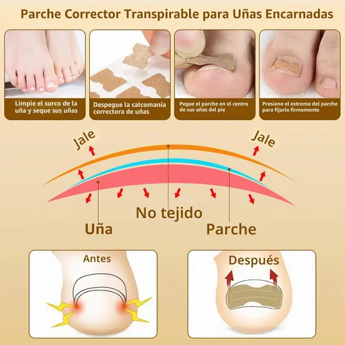 Vista 3 de Juego de corrector de uñas encarnadas con tiras correctoras y lima sin dolor, kit profesional de eliminación de uñas encarnadas con herramienta