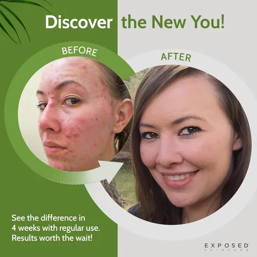 Vista 4 de Exposed Skin Care, Clearing Tonic - Tónico facial con 1% de ácido salicílico y hamamelis, tónico diario para acné de adolescentes y adultos, puntos