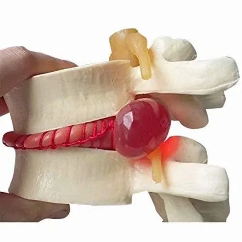 Vista 2 de Modelo de demostración de hernia de disco lumbar humana Modelo anatómico de la columna vertebral humana Amarillo