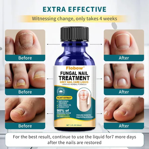 Vista 4 de Tratamiento de hongos en las uñas de los pies, tratamiento de hongos en las uñas extra fuerte para uñas, amarillas, decoloradas, uñas rotas