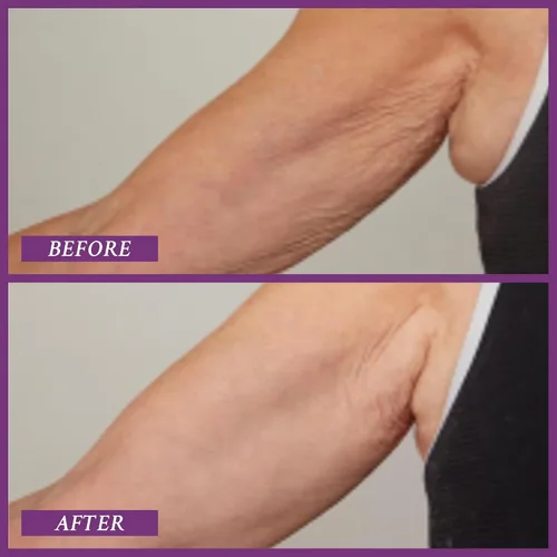 Vista 4 de PRAI Beauty Ageless Upper Arm Creme, Anti-Aging and Repairing Body Cream, Skin Firming and Tightening Lotion for Upper Arm, Firming Lotion for Loose