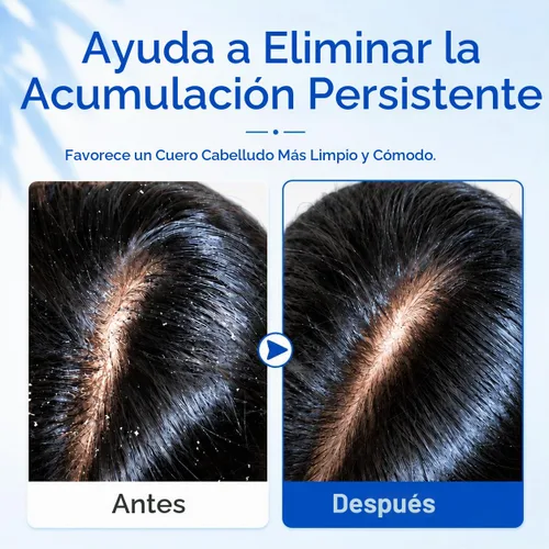 Vista 7 de Ketoconazole 1% Champú anticaspa Picazón Cuero cabelludo Flake Control 6.8 Champú anticaspa Cuidado del cuero cabelludo Ayuda a controlar