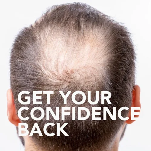 Vista 3 de Equate - Tratamiento de crecimiento del cabello para hombres, extra fuerte, suministro de 3 meses, botellas de 2 onzas, 3 unidades, solución eficaz