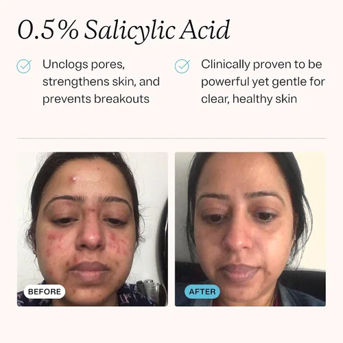 Vista 3 de MDacne Limpiador facial hidratante con ácido salicílico 0.5% - Tratamiento para el acné con ingredientes a base de plantas para eliminar la suciedad