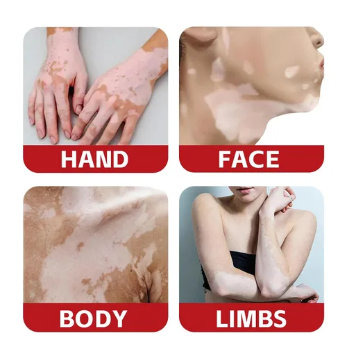 Vista 4 de Spray de tratamiento de vitíligo, tratamiento de vitíligo natural para la piel, mejora la pigmentación de la piel, crema de vitíligo adecuada