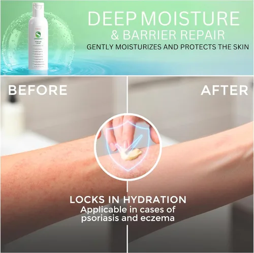 Vista 5 de SORARESAL Crema para la psoriasis – Remedio de confort con aceite de cártamo, aceite de coco y ácido salicílico para la picazón, la piel escamosa