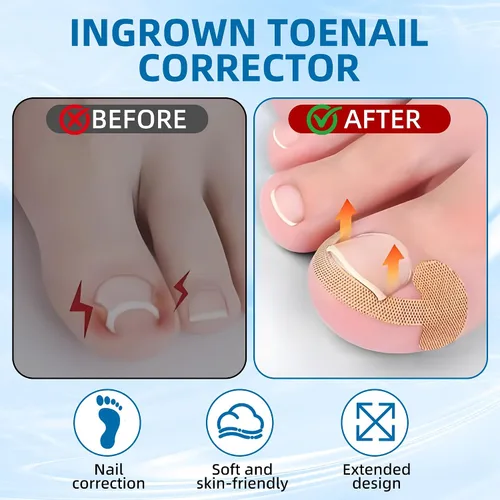 Vista 5 de Corrector de uñas encarnadas, kit de herramientas profesionales para uñas encarnadas con tiras de uñas de los pies, parche corrector de uñas curvas