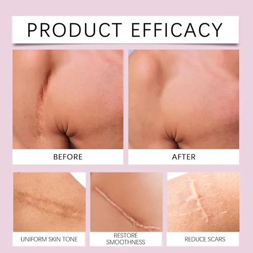 Vista 3 de Scarlette Cinta de colágeno, hojas de colágeno Scarlette para cicatrices y arrugas, tiras de silicona para eliminar cicatrices para mujeres