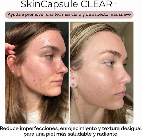 Vista 3 de Hush & Hush Suplementos para el acné para una piel clara – Fórmula clínicamente probada para reducir brotes e imperfecciones – Apoya el equilibrio