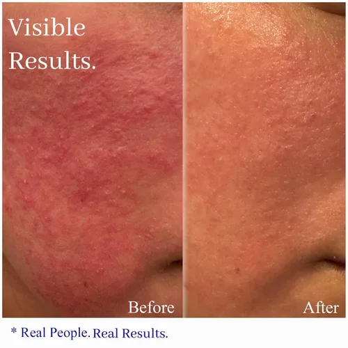 Vista 2 de Hey Honey Skincare Relax - Crema instantánea de alivio de rosácea para pieles sensibles Hidratante facial calmante para enrojecimiento e