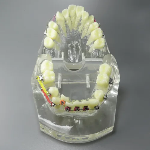 Vista 8 de Modelo dental de los dientes del tratamiento de ortodoncia de la maloclusión con los soportes del metal Alambres Cadenas y aros coloridos