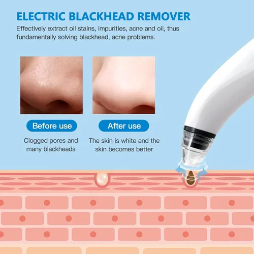 Vista 6 de Aspiradora eliminadora de puntos negros, aspiradora eléctrica de poros, herramienta de extracción de cabeza negra, limpiador de poros para hombres