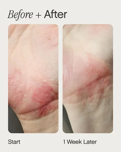 Vista 4 de Topicals Crema hidratante para piel seca, sensible y propensa al eczema, hidratante instantáneo calmante y alivio del eccema para rostro y cuerpo
