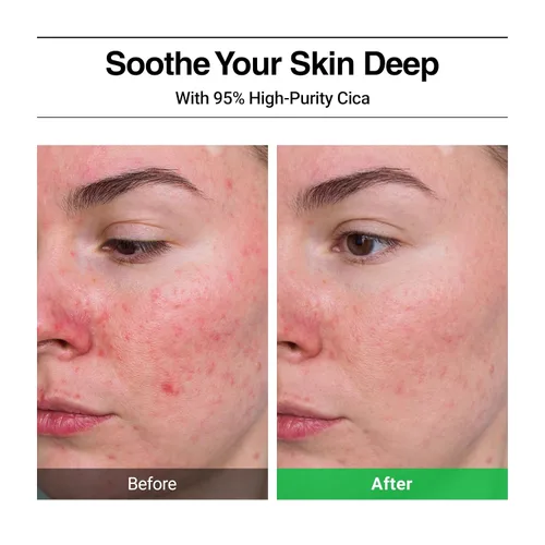 Vista 3 de WELLAGE Crema calmante Cica - Hidratante calmante facial coreano, madecassoside de alta pureza con pantenol de centella asiática, calma la piel