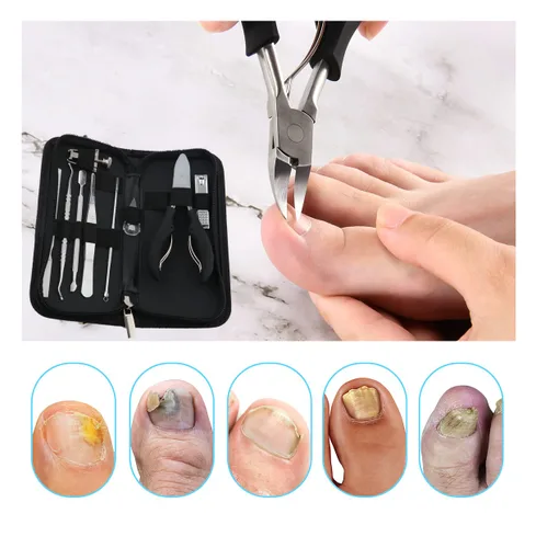 Vista 3 de Bcabo Kit de herramientas de uñas encarnadas, herramienta de pie de tratamiento de uñas, cortaúñas encarnadas, cortaúñas encarnadas, levantador