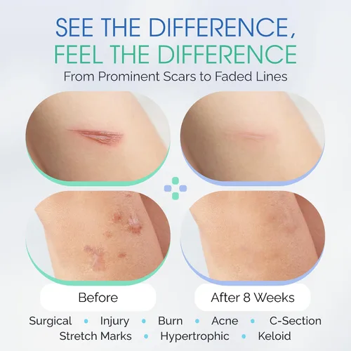 Vista 5 de Suero de gel para cicatrices de silicona 100% – Aplicador de cepillo ultrasuave para procedimientos cosméticos y exfoliaciones faciales, cuidado