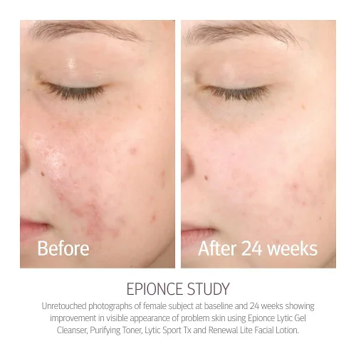 Vista 3 de Epionce Renewal Lite - Loción facial ligera hidratante antienvejecimiento para pieles mixtas con grasa y problemática, cuidado de la piel dermatólogo