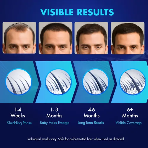 Vista 6 de Crecimiento del cabello de minoxidil al 5% para hombres y mujeres: solución tópica de minoxidil extra fuerte para adultos con líneas de cabello