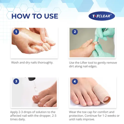 Vista 5 de Alivio de Uñas Encarnadas: Herramienta para Uñas Encarnadas para Hombres Mujeres - Kit de Eliminación de Uñas Encarnadas - Gotas Correctoras de Uñas