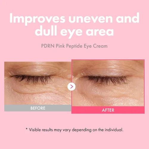 Vista 2 de TOSOWOONG PDRN Crema para ojos con péptidos rosados y ADN de salmón PDRN 5,000ppm, fórmula antienvejecimiento con cafeína y retinol liposómico