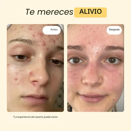 Vista 3 de MyMagicHealer Cuidado de Brotes de Tomillo y Árbol de Té Cabello encarnado, protuberancias de afeitar, espinillas ciegas, bartolín, quistes