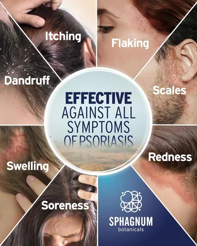 Vista 2 de Sphagnum Botanicals Champú de psoriasis con ácido salicílico para mujeres y hombres, alivio natural para cuero cabelludo seco, picazón, escamoso