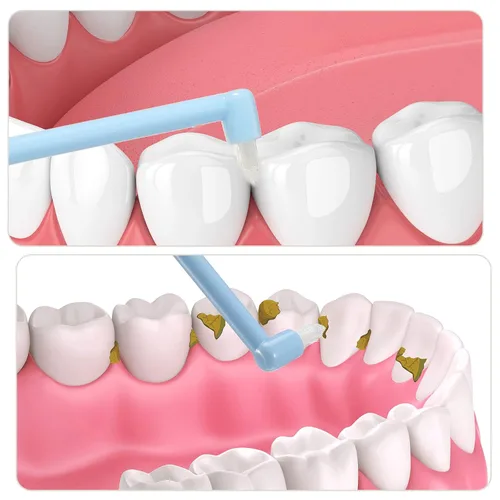 Vista 3 de Patelai 6 unids End Tuft Cepillo de dientes Single Tufted Cepillo de dientes Interdental Cepillos Interdentales Removedor de Manchas de Dientes
