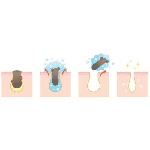 Vista 5 de DrFormulas Reductor de poros y tratamiento de puntos negros con ácido salicílico y niacinamida Limpieza profunda, máscara de acné minimizadora