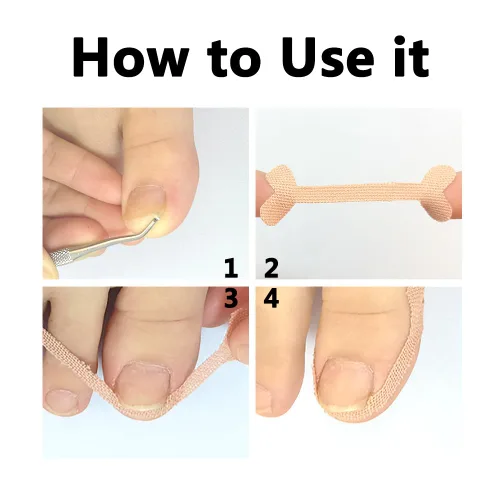 Vista 3 de Tratamiento de uñas encarnadas, 50 parches correctores de uñas encarnadas, calcomanías de corrección de uñas de los pies, herramienta profesional