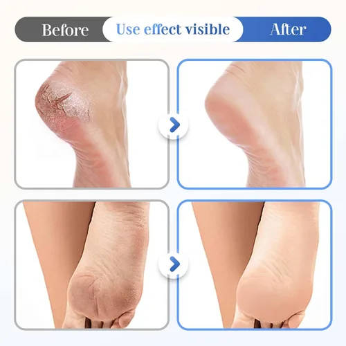 Vista 7 de Crema hidratante y antiagrietamiento para pies, 60% urea más 2% ácido salicílico, crema hidratante y antiagrietamiento para pies secos agrietados