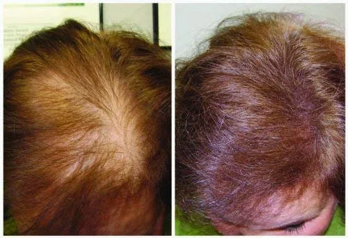 Vista 2 de Miracle Plus Champú de cabello grueso para cabello fino para hombres y mujeres, 8 onzas.