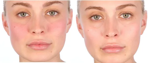 Vista 3 de Nakery Tratamiento de reparación intensiva para aliviar el eccema crema calmante para rostro y cuerpo 2% de avena coloidal Alivio inmediato