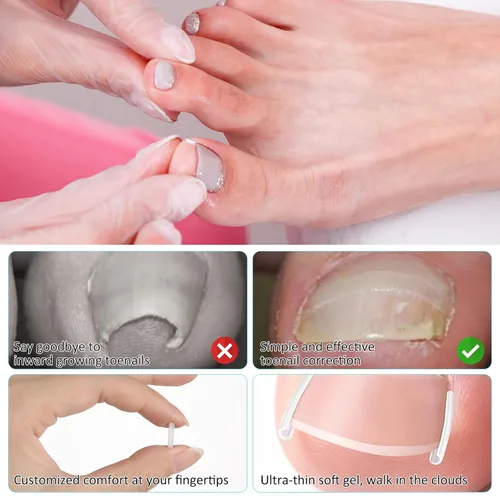 Vista 3 de (50+1) Juego de tratamiento corrector de uñas encarnadas, kit profesional de eliminación de uñas encarnadas sin dolor con levantador de uñas