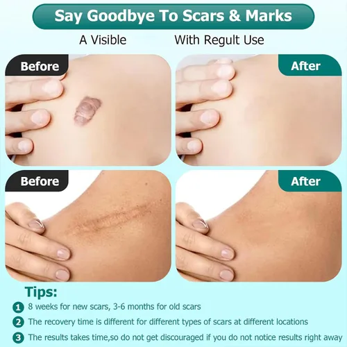 Vista 2 de Gel avanzado para cicatrices quirúrgicas, cara, cuerpo, piernas, quemaduras, acné, cesárea, estrías, queloides, eliminación eficaz de cicatrices