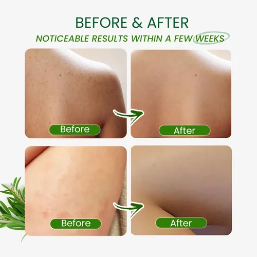 Vista 5 de PHARMBANNER Gel de baño antifúngico de árbol de té - Alivia la foliculitis, el acné, la picazón de deportista, el pie de atleta, la tiña, la tiña