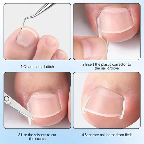Vista 7 de Juego de corrector profesional de uñas encarnadas con tiras correctoras, kit de eliminación de uñas encarnadas, juego de herramientas de pedicura