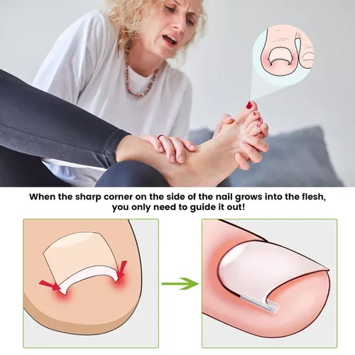 Vista 2 de BEZOX Juego de corrector de uñas encarnadas con cuchilla recta, 40 tiras alisadoras de uñas sin dolor con levantador de uñas de los pies, kit