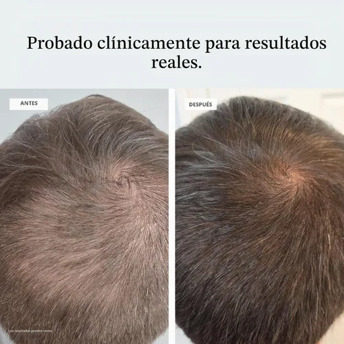 Vista 4 de Suero Densificante para el cuero cabelludo, 1 fl oz, con Procapil y Redensyl