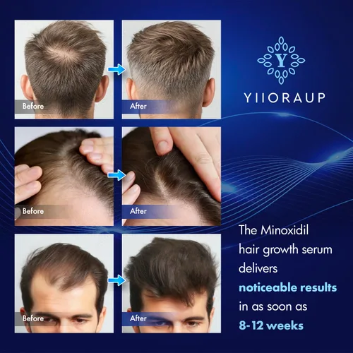 Vista 5 de Crecimiento del cabello de minoxidil al 5% para hombres y mujeres: solución tópica de minoxidil extra fuerte para adultos con líneas de cabello